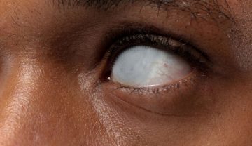 Verdadeira origem da expressão ‘ Custar os olhos da cara’